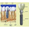 Имплантация зубов